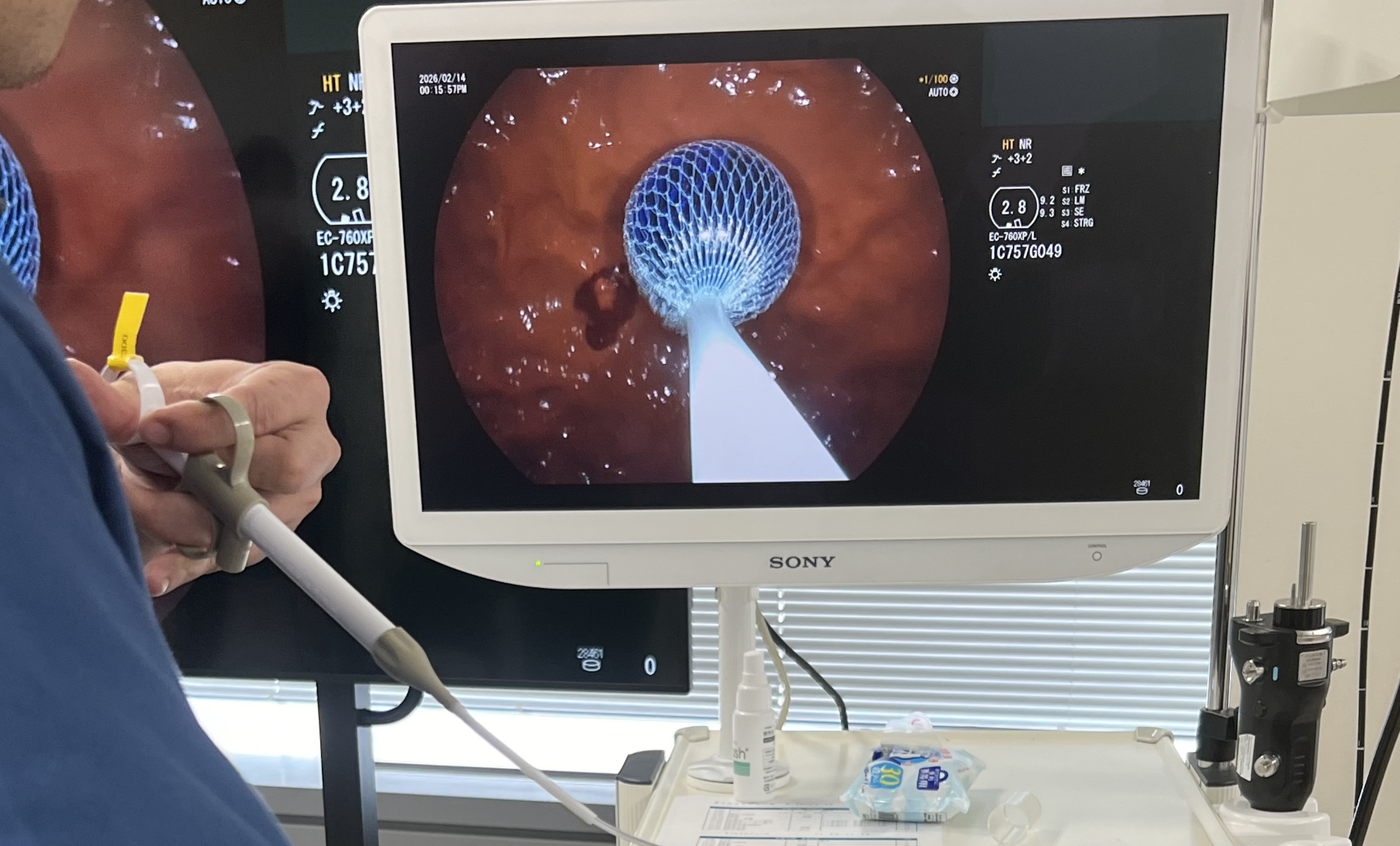 モニターに映るボールのようなものと、それを取り除くための機器